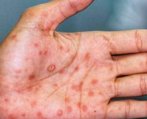 El Gobierno monitorea el primer caso sospechoso de viruela del mono en el país