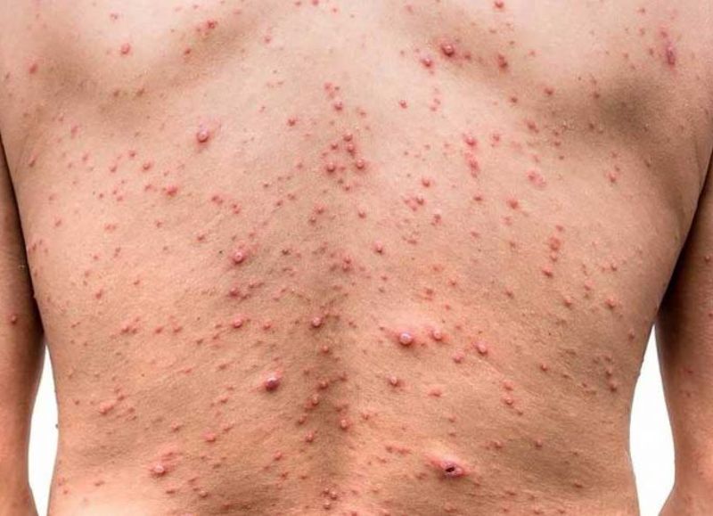 Confirman la primera muerte por viruela del mono en Chile